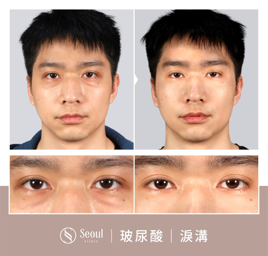 玻尿酸淚溝-帥氣網紅攝影師阿古-首爾醫美組診所 玻尿酸淚溝-帥氣網紅攝影師阿古-首爾醫美組診所