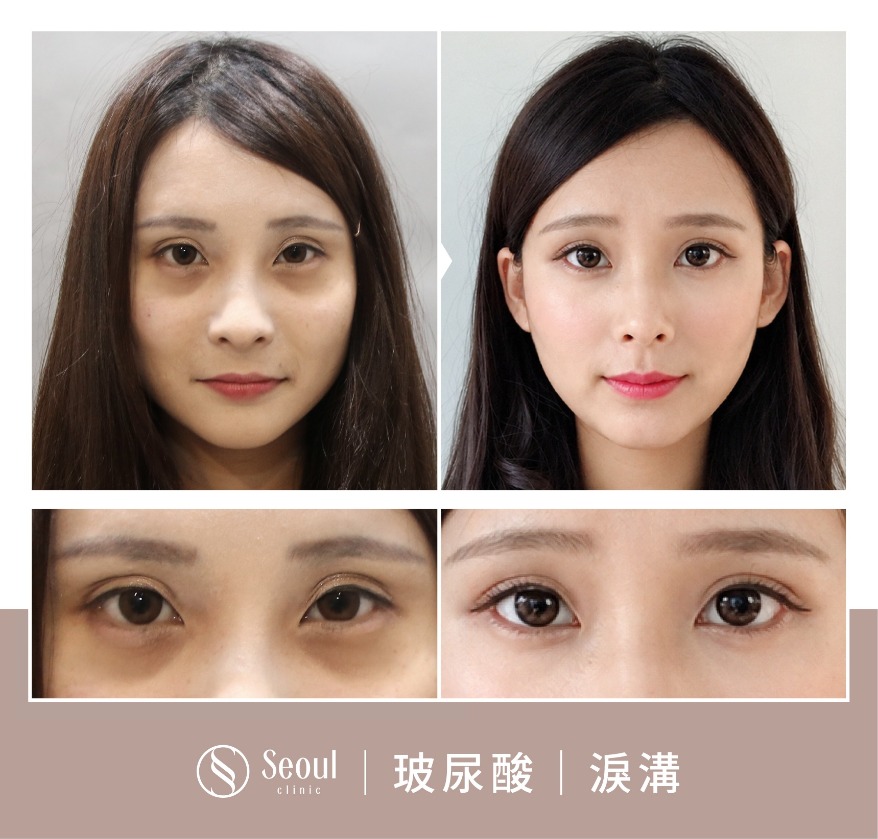 玻尿酸注射-玻尿酸淚溝案例BA3-首爾醫美診所 玻尿酸注射-玻尿酸淚溝案例BA3-首爾醫美診所