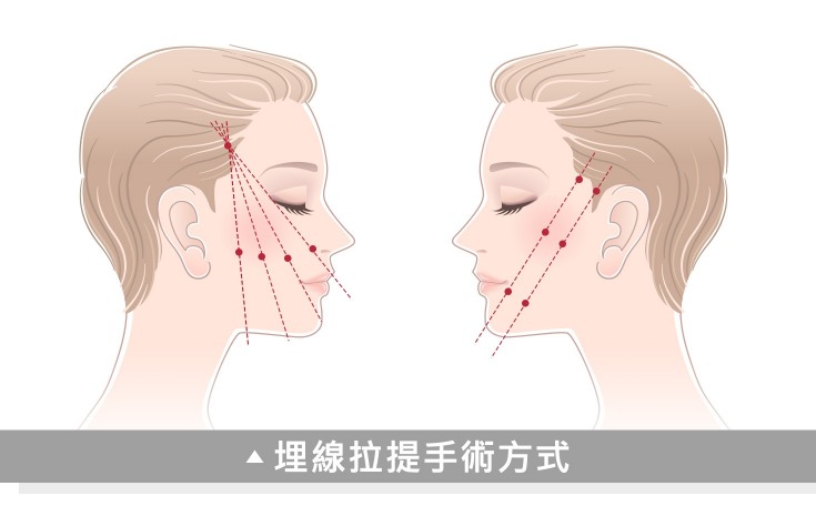 埋線_治療方式_首爾醫美