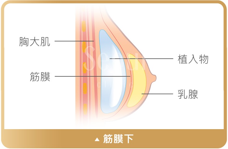 果凍矽膠隆乳_筋膜下_首爾醫美