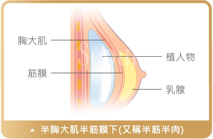 果凍矽膠隆乳_半胸大肌半筋膜下_首爾醫美