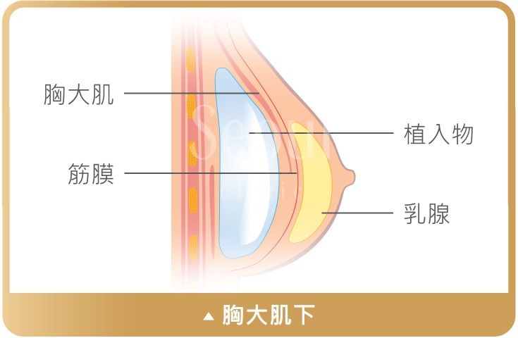 果凍矽膠隆乳_胸大肌下_首爾醫美