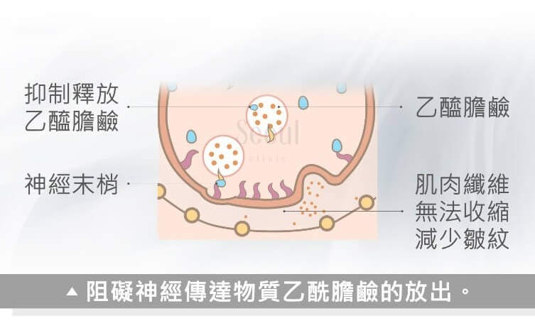 瘦小臉除皺_治療原理_首爾醫美