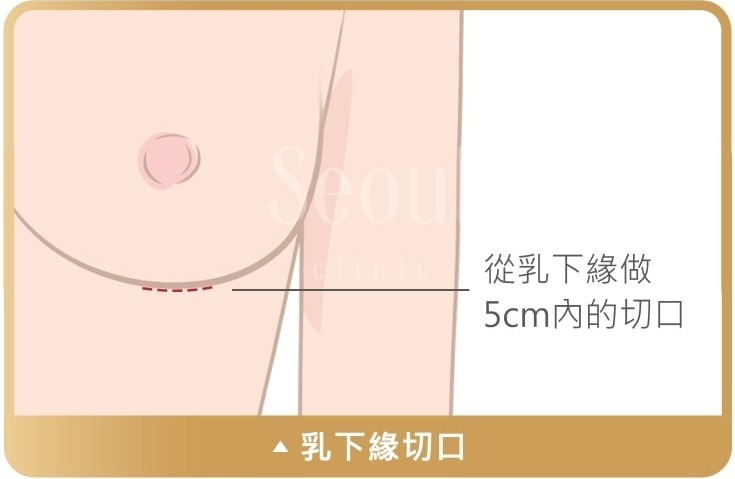 果凍矽膠隆乳_乳下緣切口_首爾醫美