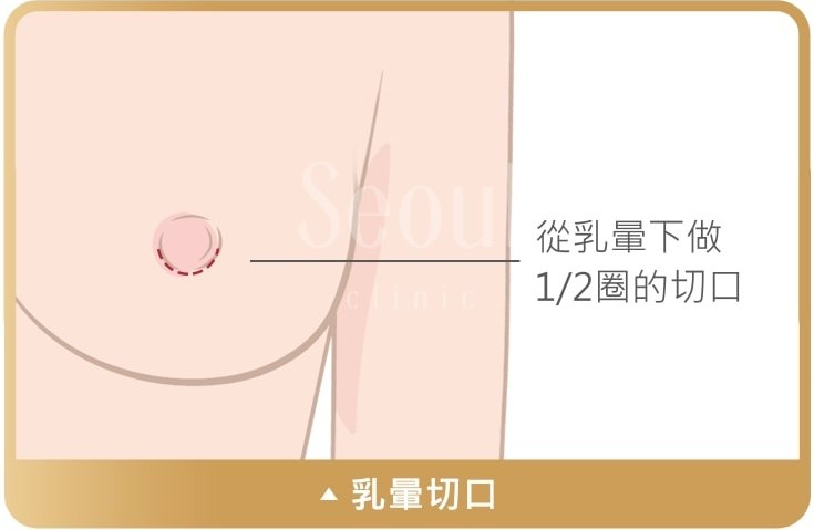 果凍矽膠隆乳_乳暈切口_首爾醫美