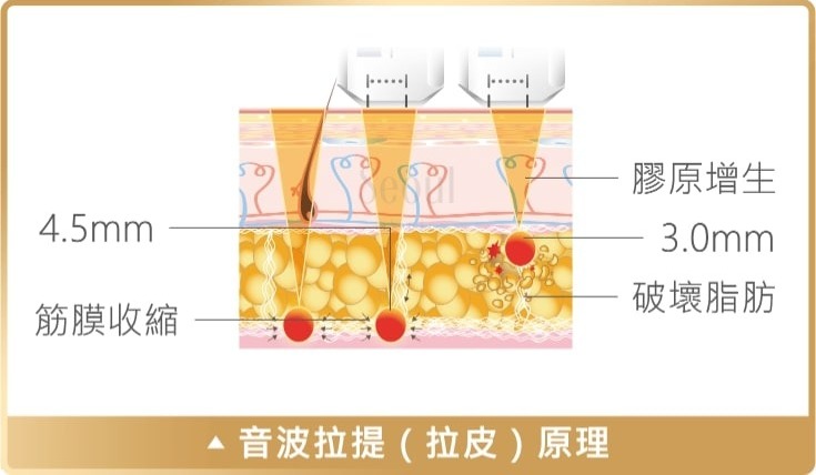 音波拉皮_拉提原理_首爾醫美