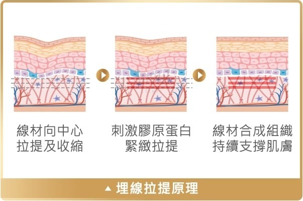 埋線_拉提原理_首爾醫美