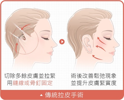 拉皮_傳統拉皮手術_首爾醫美