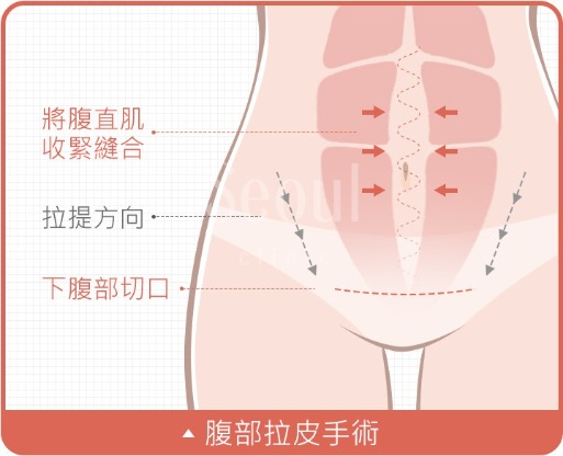 拉皮_腹部拉皮手術_首爾醫美