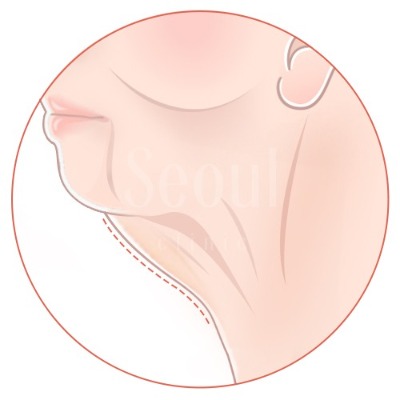 拉皮_中下臉拉提_首爾醫美