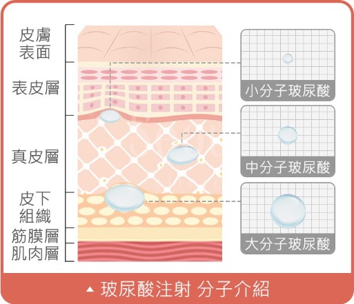 玻尿酸注射_分子介紹_首爾醫美