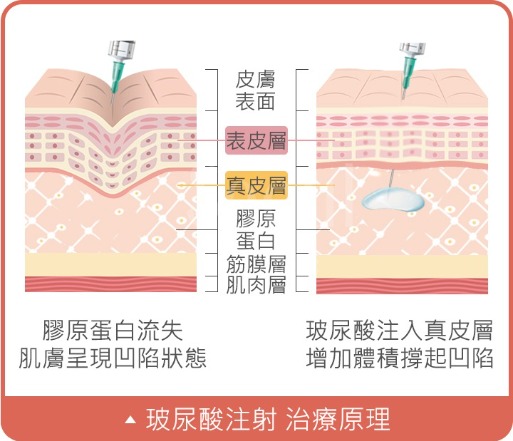 玻尿酸注射_治療原理及功效_首爾醫美