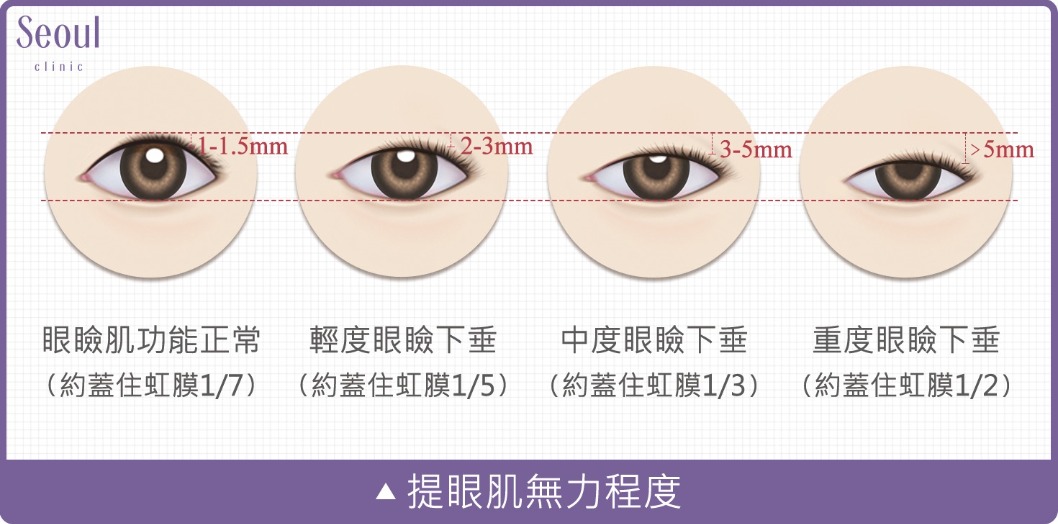 提眼肌無力類型_首爾醫美