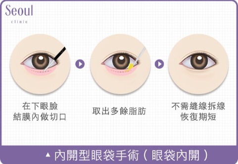 眼袋手術切口位置_內開型眼袋手術（眼袋內開）_首爾醫美