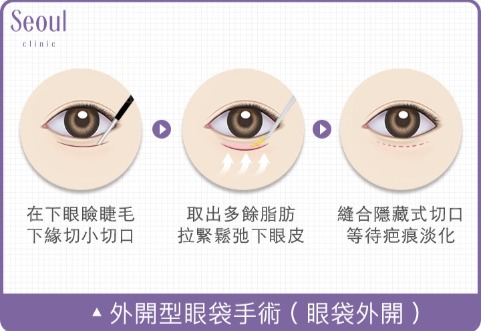 眼袋手術切口位置_外開型眼袋手術（眼袋外開）_首爾醫美