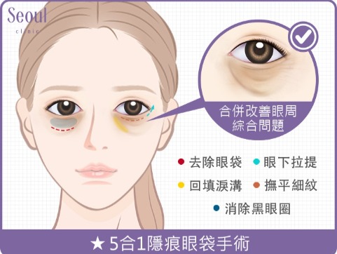 眼袋手術方式_5合1隱痕眼袋手術_首爾醫美