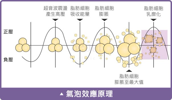 抽脂手術_氣泡效應原理_首爾醫美