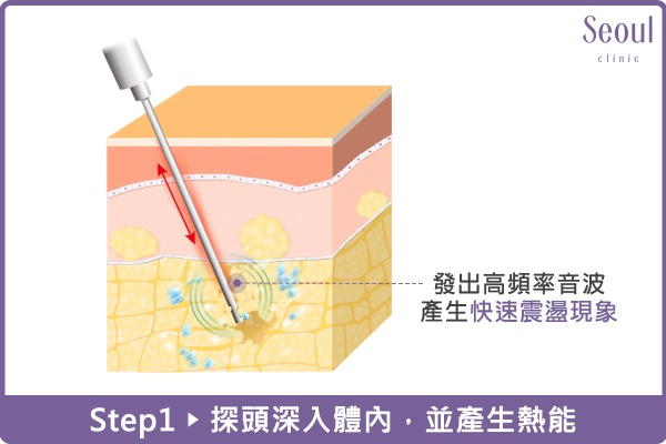 抽脂手術_手術方式_首爾醫美