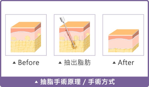 抽脂手術_手術原理_首爾醫美