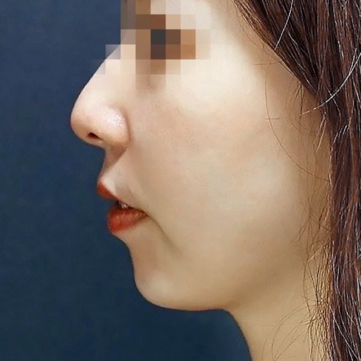 瑞絲朗_瑞絲朗施打後_首爾醫美