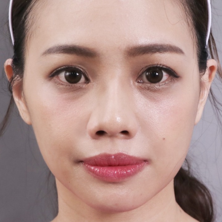 瑞絲朗_瑞絲朗施打前_首爾醫美