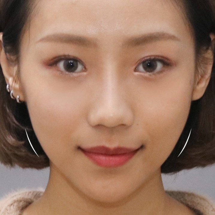 瑞絲朗_瑞絲朗施打後_首爾醫美