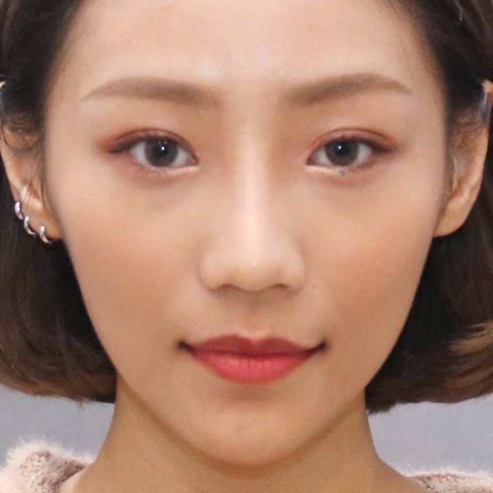 瑞絲朗_瑞絲朗施打前_首爾醫美