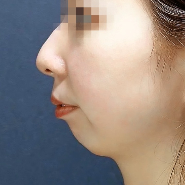 瑞絲朗_瑞絲朗施打前_首爾醫美