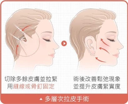 拉皮_傳統拉皮手術_首爾醫美