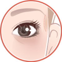 喬雅露_適應對象欲局部精雕者_首爾醫美