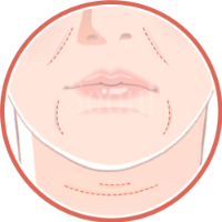 喬雅露_適應對象欲填補凹陷者_首爾醫美