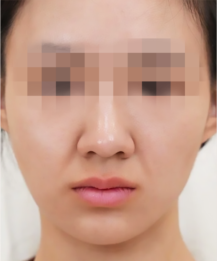 喬雅露_喬雅露施打前後_首爾醫美