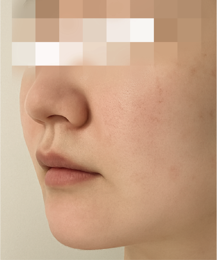 喬雅露_喬雅露施打前後_首爾醫美