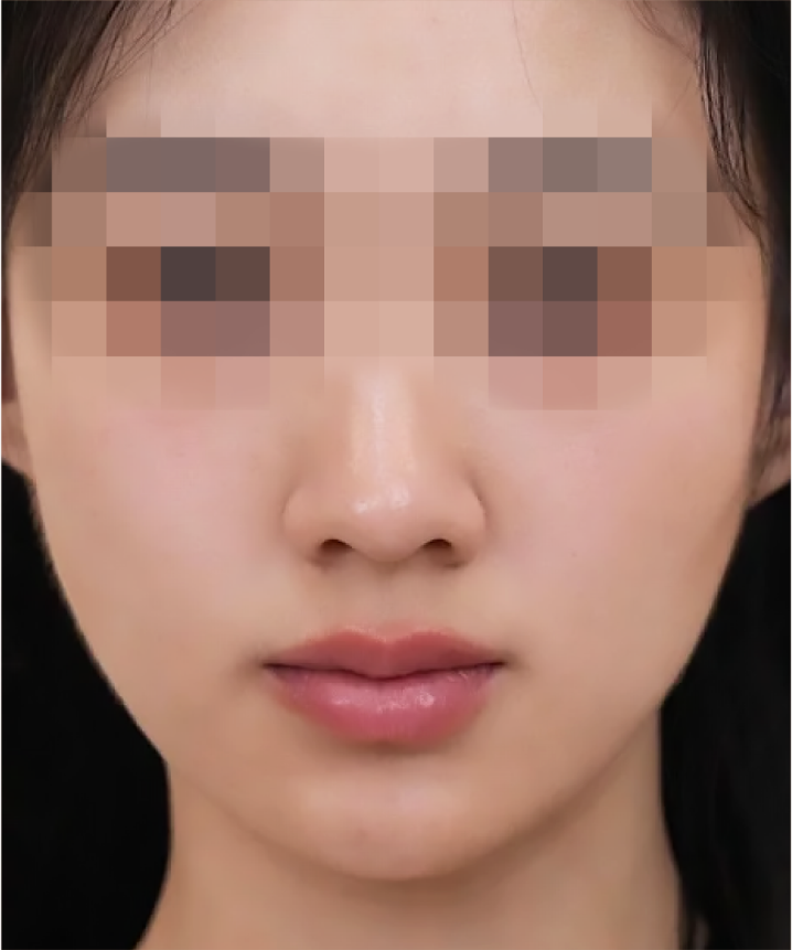 喬雅露_喬雅露施打前後_首爾醫美