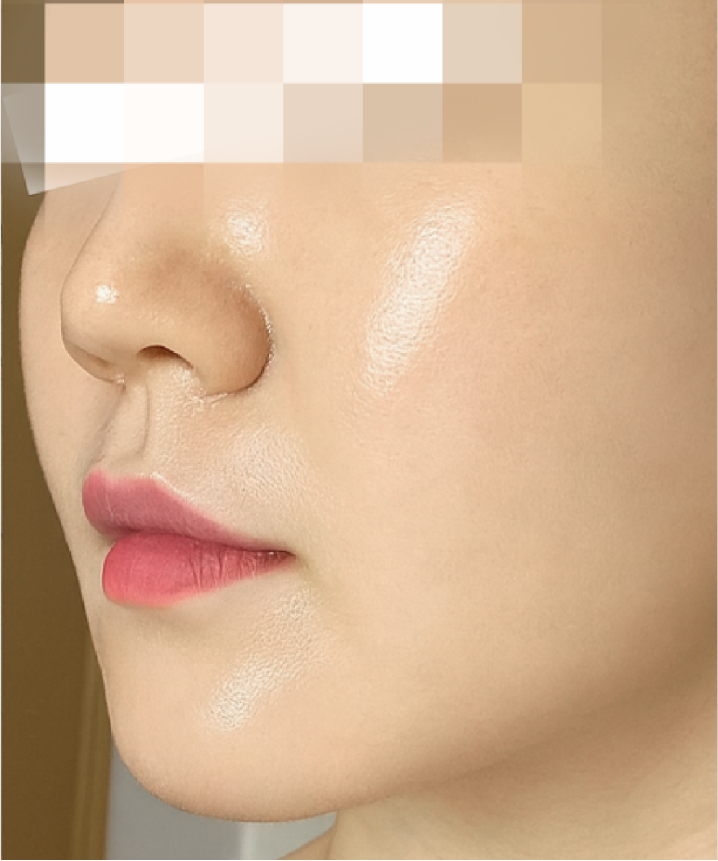 喬雅露_喬雅露施打前後_首爾醫美