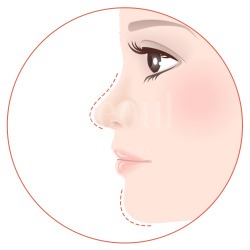 喬雅露_適應對象欲改善輪廓者_首爾醫美