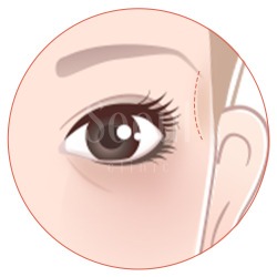 喬雅露_適應對象欲局部精雕者_首爾醫美