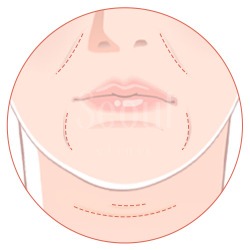 喬雅露_適應對象欲填補凹陷者_首爾醫美