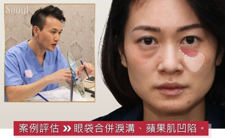 5合1隱痕眼袋手術 只要一個下午茶時間 全方位改善眼周狀況 素人實證queenie