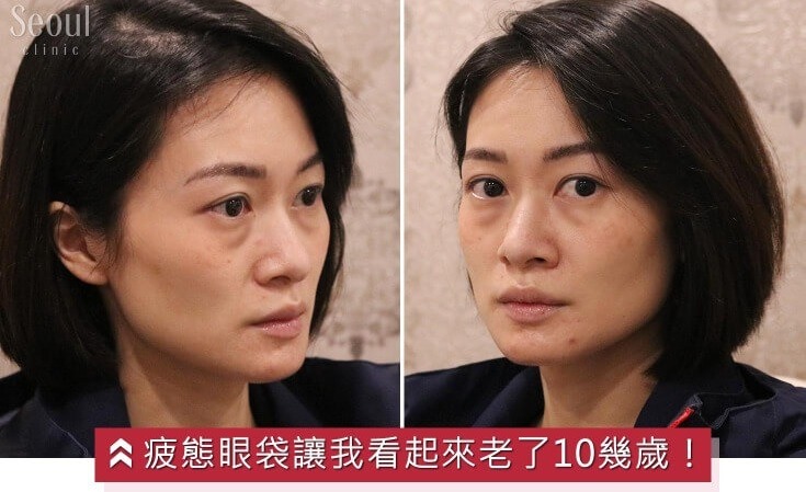 眼袋手術_案例故事_首爾醫美