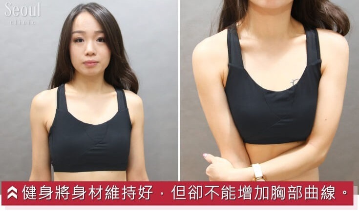 果凍隆乳_案例故事_首爾醫美