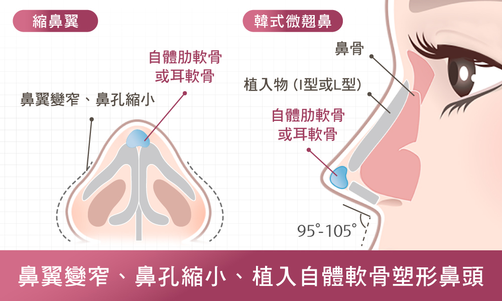 歐韓多段式隆鼻手術-隆鼻介紹-首爾醫美