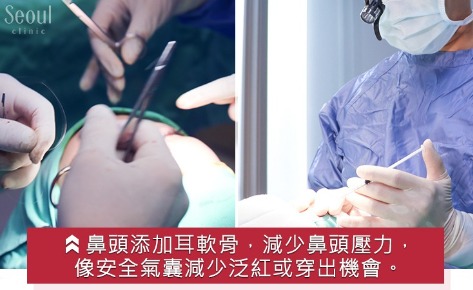歐韓多段式隆鼻手術_治療_首爾醫美