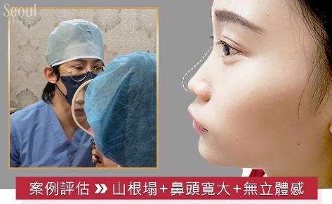 歐韓多段式隆鼻手術_諮詢_首爾醫美