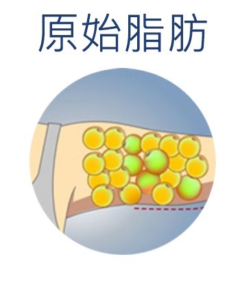 首爾醫美抽脂手術_抽脂原理