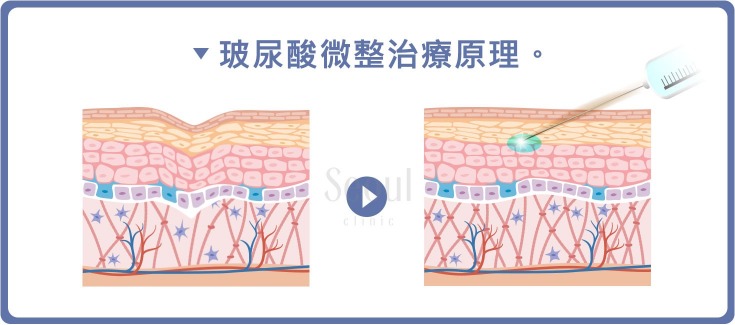 玻尿酸_微整治療原理_首爾醫美