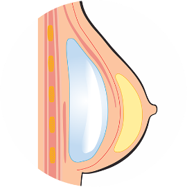 果凍隆乳_半胸大肌半筋膜下_首爾醫美