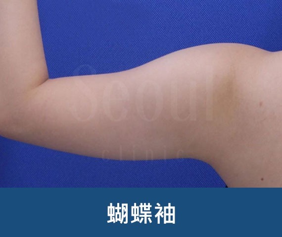 首爾醫美抽脂手術_術前分享照