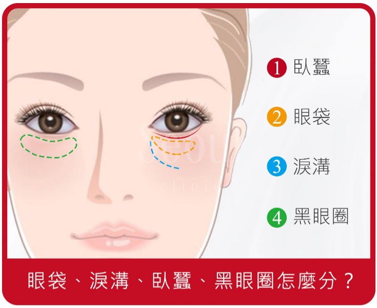 眼袋 淚溝 臥蠶 黑眼圈怎麼分 一篇讓你看懂如何有效消除眼袋 眼袋 淚溝 臥蠶 黑眼圈怎麼分 一篇讓你看懂如何有效消除眼袋