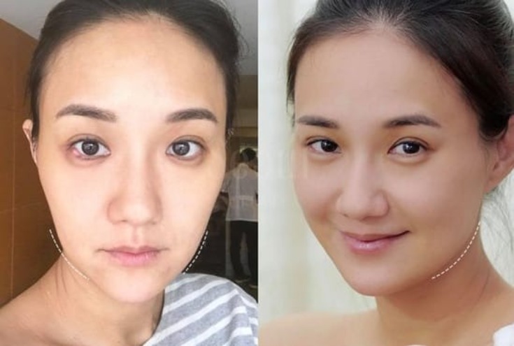 音波拉提_何妤玟實證_首爾醫美